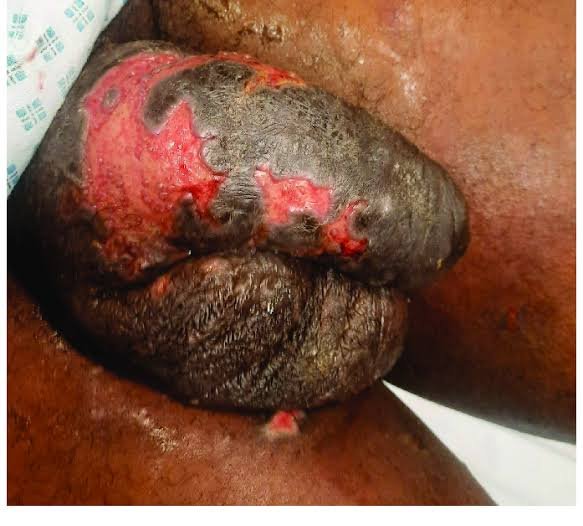 Infection spreading when left unaddressed