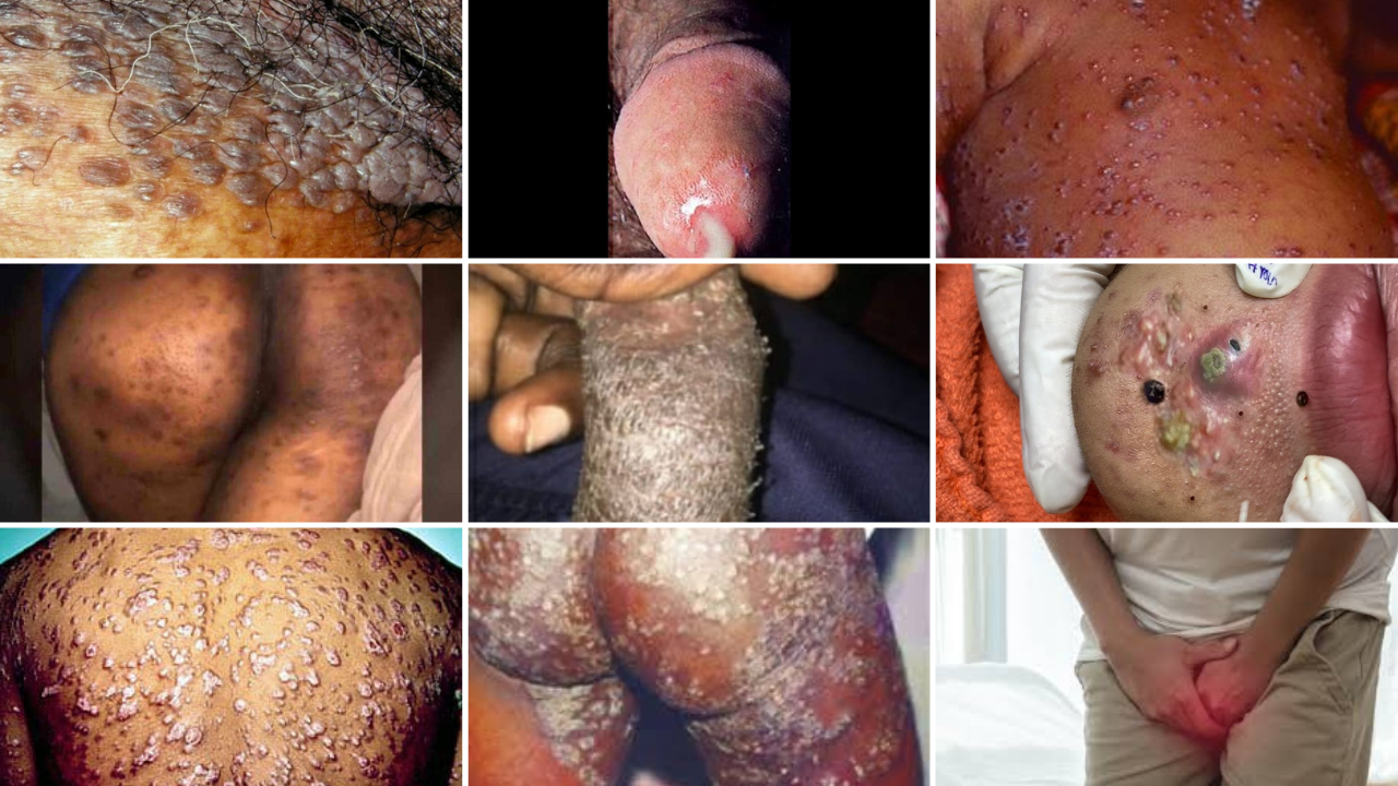 Worsening symptoms when an infection is left untreated